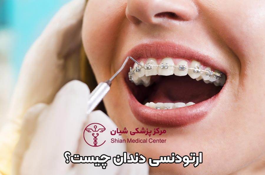 ارتودنسی دندان چیست؟ انواع ارتودنسی