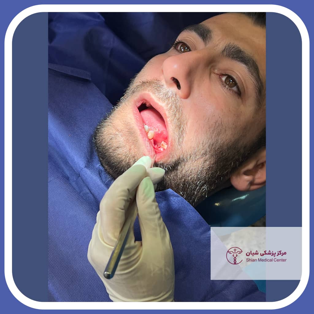 شیوه جایگذاری ایمپلنت