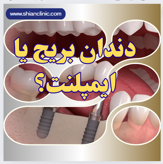 دندان بریج یا ایمپلنت