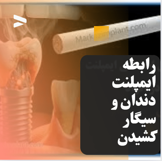رابطه ایمپلنت دندان و سیگار کشیدن