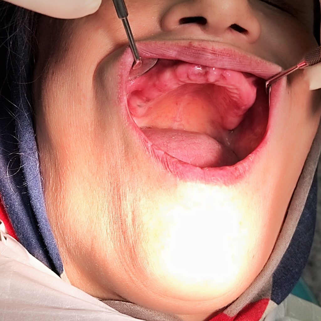 ایمپلنت دندان کشیده شده