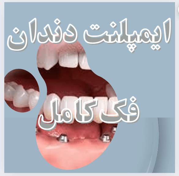 ایمپلنت دندان فک کامل