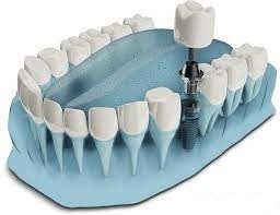 کیا ایمپلنت کردن3