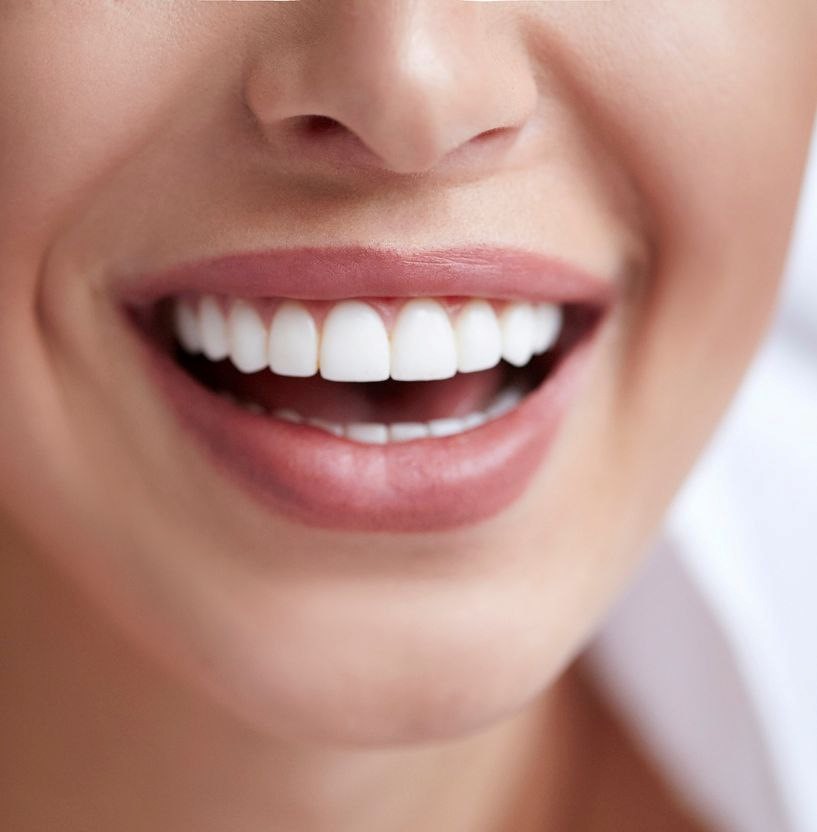 کامپوزیت دندان های کج