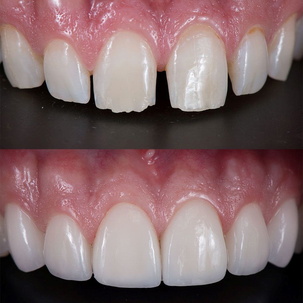 کامپوزیت دندان های کج