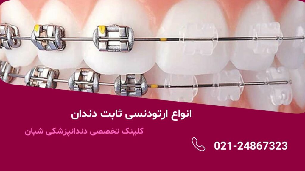 انواع ارتودنسی ثابت دندان