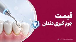 قیمت جرم گیری دندان