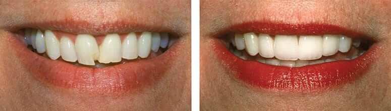 پوسیدگی دندان بعد از کامپوزیت