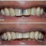 پوسیدگی دندان بعد از کامپوزیت