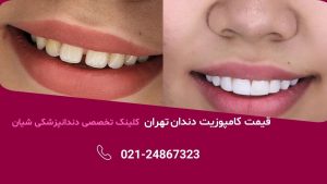قیمت کامپوزیت دندان